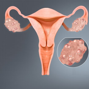 Ovario Polisctico