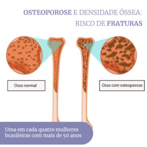 osteoporose na menopausa - Dr Lizanka Marinheiro